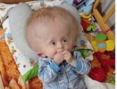 В Кирове закрыли сбор на операцию для ребенка с врожденной гидроцефалией