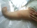 Специалисты Центра травматологии лечат младенца с врожденной косолапостью