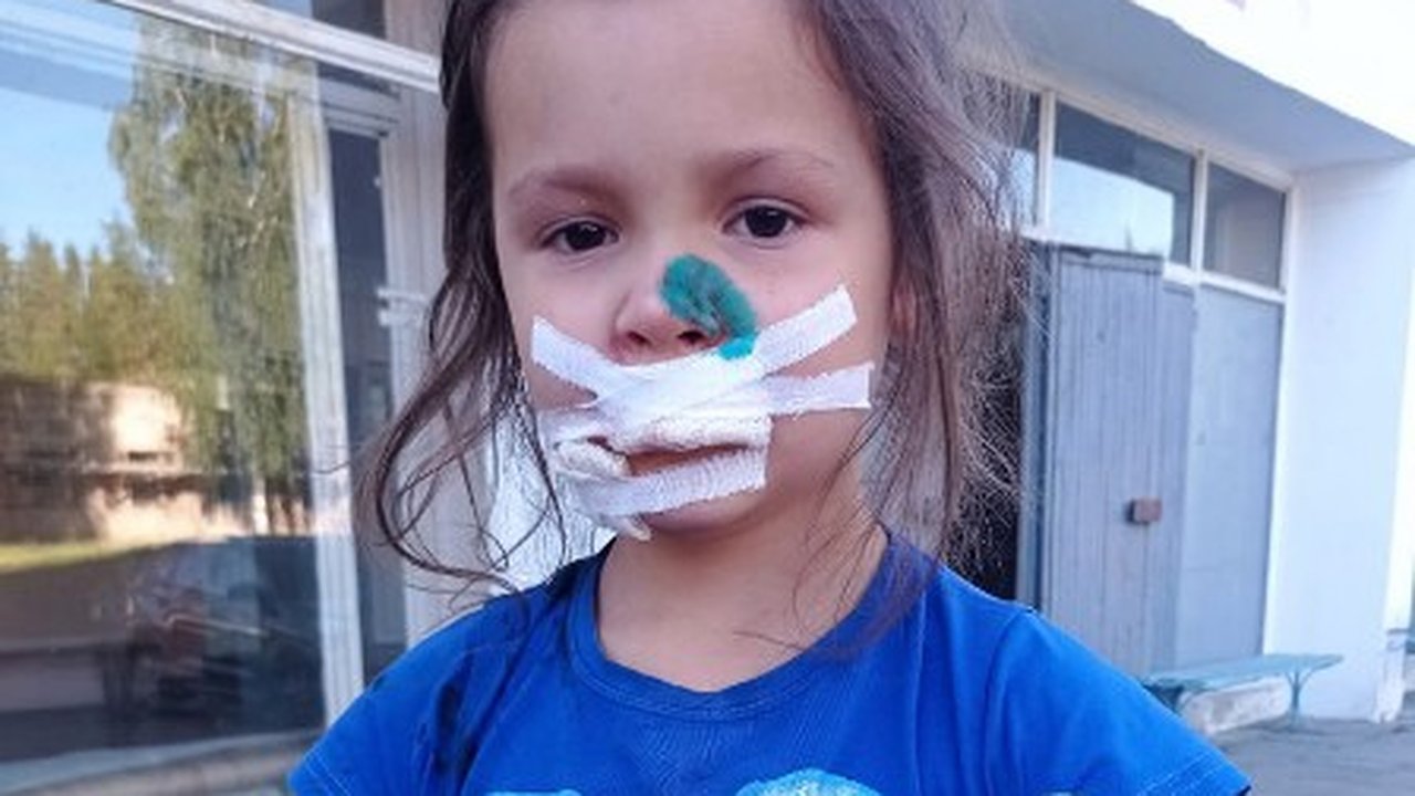 Главная картинка новости: “Вынуждена кормить пюре для 3-месячных детей”: в Омутнинске собака изуродовала лицо 6-летней девочки