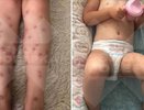 Прогрызают кожу и могут попасть в кровь: в России бьют тревогу из-за заражения личинками червей-паразитов во время купания