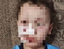 Мальчику из Яранска присудили компенсацию после нападения собаки
