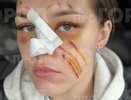 "Полностью от рубцов не избавиться": учительница с изуродованным лицом из Кирова обжалует приговор обидчице