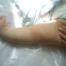 Специалисты Центра травматологии лечат младенца с врожденной косолапостью